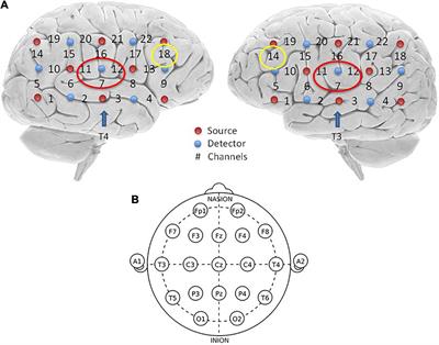 Notched Sound Alleviates Tinnitus by Reorganization Emotional Center